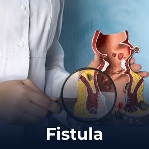 Fistula