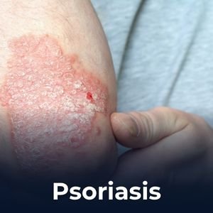 Psoriasis